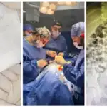 إنقاذ طفل بمستشفى المنصورة الجامعي من 20 جسماً غريباً بينها بطاريات ومغناطيسات