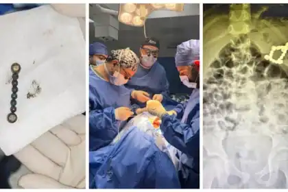 إنقاذ طفل بمستشفى المنصورة الجامعي من 20 جسماً غريباً بينها بطاريات ومغناطيسات