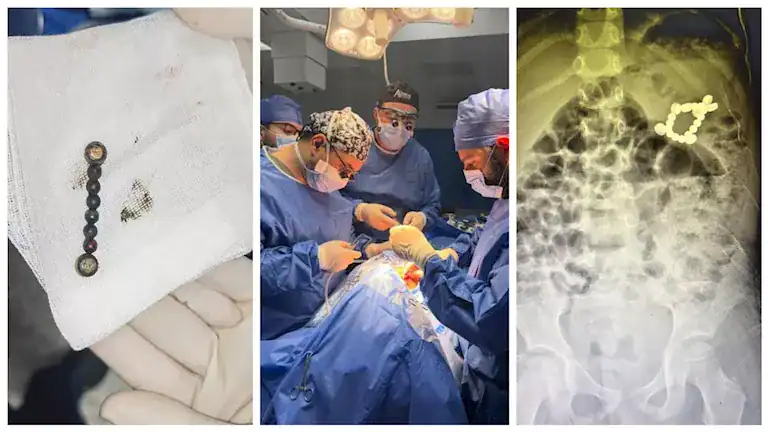 إنقاذ طفل بمستشفى المنصورة الجامعي من 20 جسماً غريباً بينها بطاريات ومغناطيسات 1 إنقاذ طفل بمستشفى المنصورة الجامعي من 20 جسماً غريباً بينها بطاريات ومغناطيسات